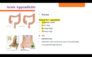 Acquit appendicitis img
