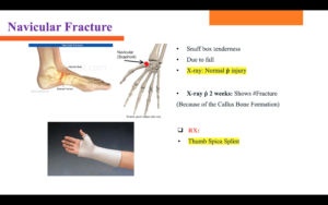 fracture finger img